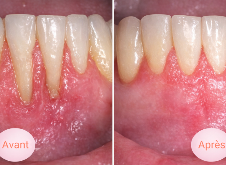 avant après traitement déchaussement des dents