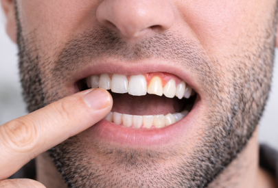 dent du haut qui se déchausse