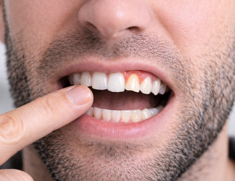 dent du haut qui se déchausse