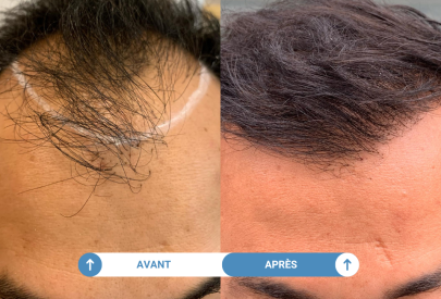 avant apres d'une greffe de cheveux réaisée dans notre clinique partenaire parisienne