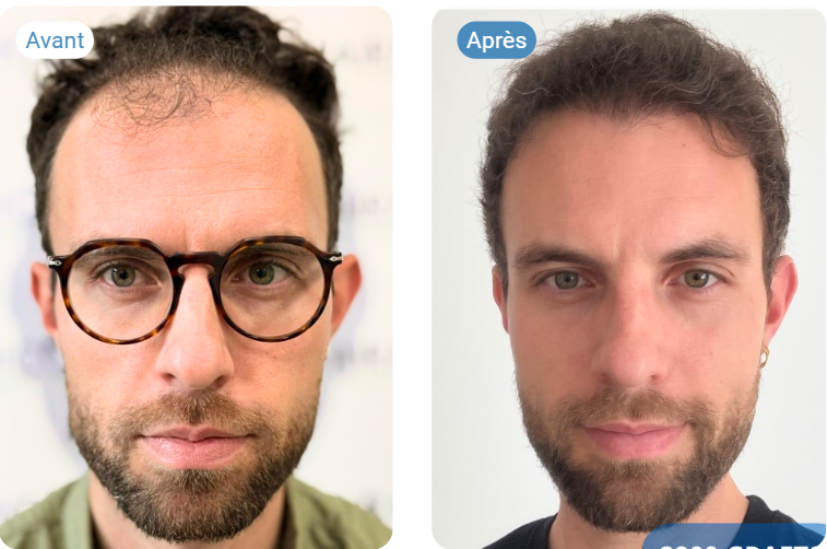 greffe de cheveux avant après clinique istanbul